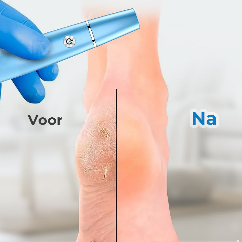 💕Moederdag Hete Uitverkoop 50%🔥Elektrische Voeten Eeltverwijderaar