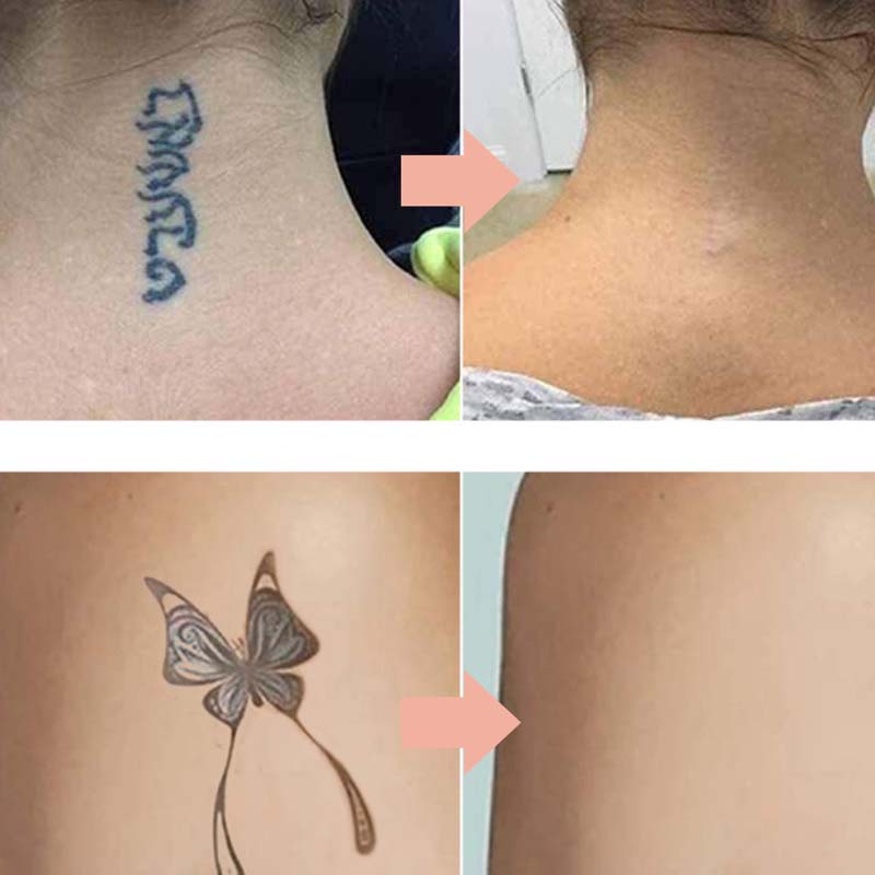 Effectieve Crème voor Tattoo Vervagen - Zachte & Veilige Formule
